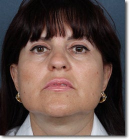 Face & Neck Lift after 624911