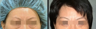 Lower Eyelid(Blepharoplasty) Surgery before 656738