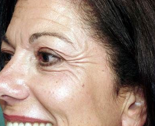 Botox for Crow's feet before 968633