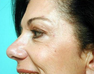 Botox for Crow's feet after 968633