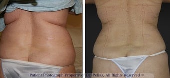 Laser Treatment in female before 1250130