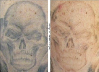 PicoSure Tattoo Removal After 1 Treatment before 1012420