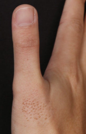 Birthmark Laser after 539861