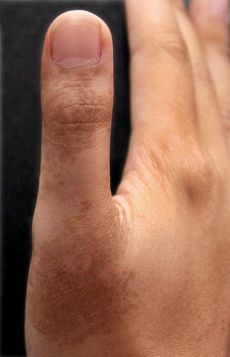 Birthmark Laser before 539861