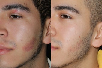 Before & After Birthmark Removal before 678452