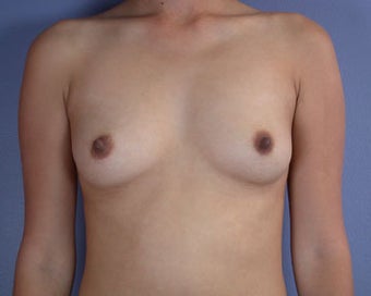 Breast Augmentation before 281392