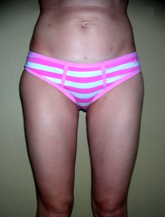 Vaser liposuction after 313443