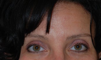 Botox and Dermal Filler to Frown Lines after 921863