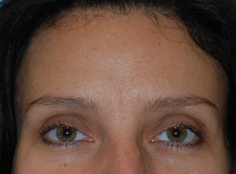 Botox and Dermal Filler to Frown Lines before 921863