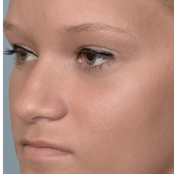 18 Year-Old Female Treated For Midface Deficiency before 806518