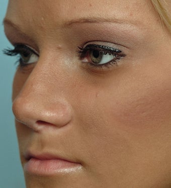 18 Year-Old Female Treated For Midface Deficiency after 806518