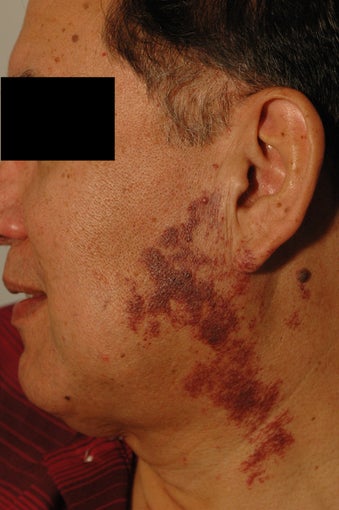 Birthmark Removal Before and After Photos before 683244