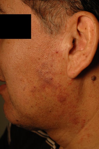 Birthmark Removal Before and After Photos after 683244