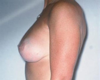 Breast Asymmetry Correction after 281314