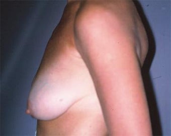 Breast Asymmetry Correction before 281314