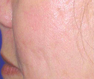 Mesotherapy after 920814