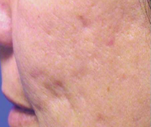 Mesotherapy before 920814