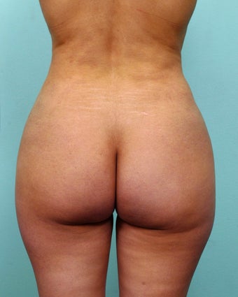 Brazilian Butt Lift 950938