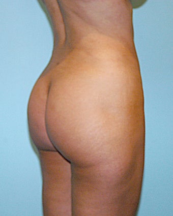 Brazilian Butt Lift after 950938