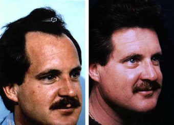 Hair Replacement before 78548