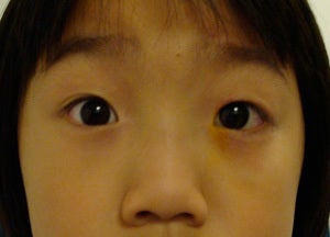 Ptosis surgery, asian eyelid surgery after 875940