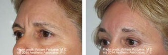 Brow Lift before 91507