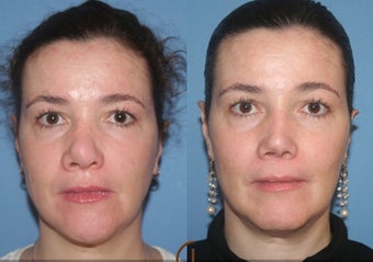 Rhinoplasty before 450419