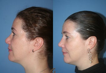 Rhinoplasty after 450419