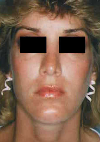 Revision Rhinoplasty after 665075