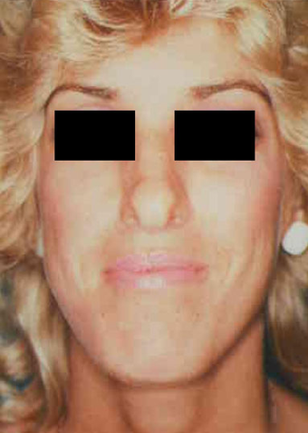 Revision Rhinoplasty before 665075