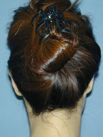 Otoplasty/Ear Surgery after 731987