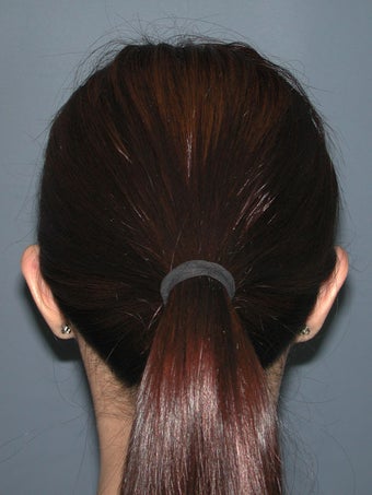 Otoplasty/Ear Surgery before 731987