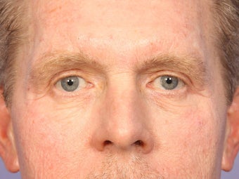 Eyelid Surgery after 280847