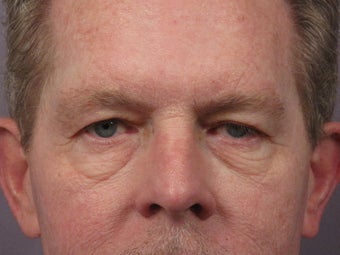 Eyelid Surgery before 280847