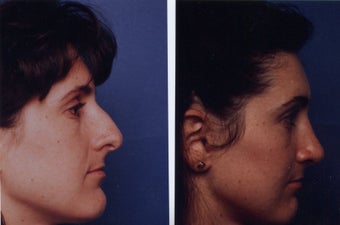 Nose before 425034