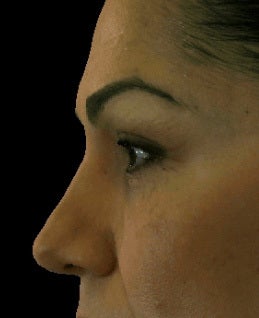 Hyaluronic acid fillers to lower lids and mid face after 875956