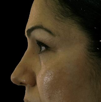 Hyaluronic acid fillers to lower lids and mid face before 875956