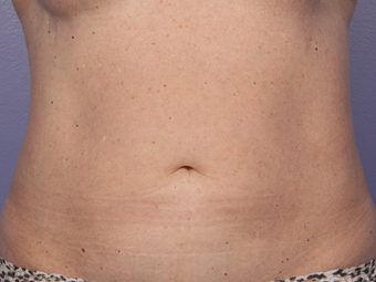 CoolSculpting by Zeltiq to Abdomen after 375517