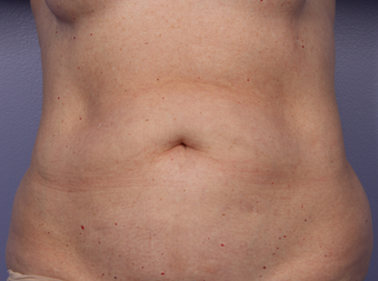 CoolSculpting by Zeltiq to Abdomen before 375517