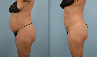 Liposuction before 379685