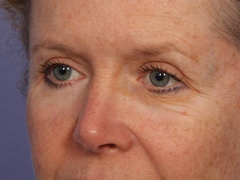 Eyelid Surgery after 280837