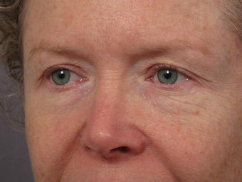 Eyelid Surgery before 280837