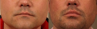 Surgisil Lip Augmentation before 1098852