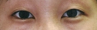 Bilateral Asian Eyelid Surgery before 861149