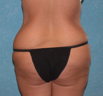Circumferential Body Lift 856570