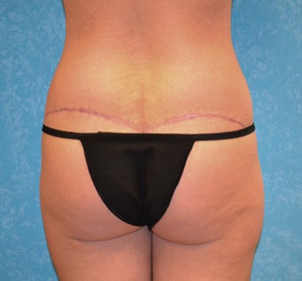 Circumferential Body Lift 856570