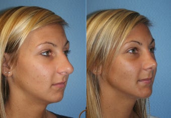 Primary Rhinoplasty after 450426