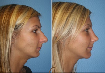 Primary Rhinoplasty before 450426