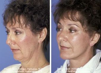 Face lift with a chin implant before 6765