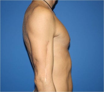 Pectoral Augmentation, Pec Implants after 665744